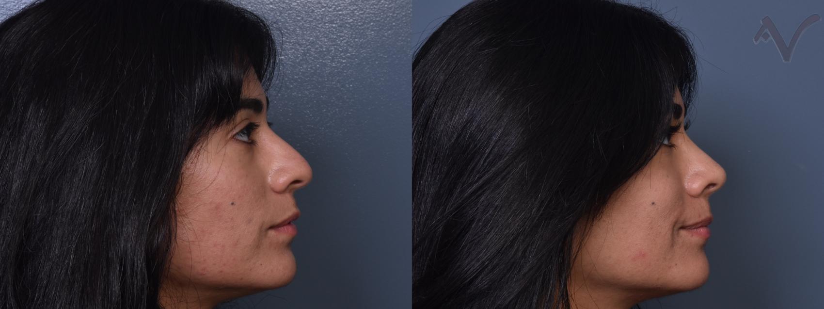 Before & After Rhinoplasty Case 369 Right Side View in Los Angeles, CA