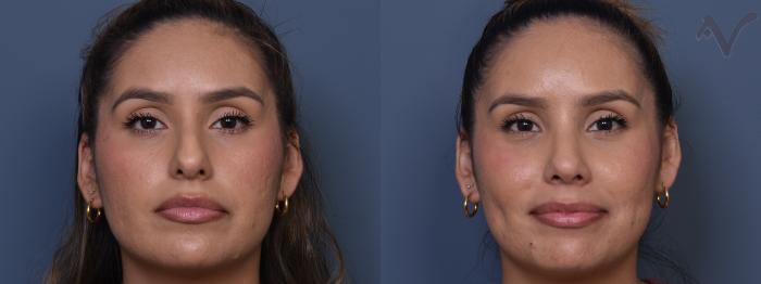 Before & After Rhinoplasty Case 370 Front View in Los Angeles, CA