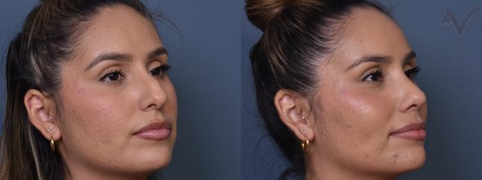 Before & After Rhinoplasty Case 370 Right Oblique View in Los Angeles, CA