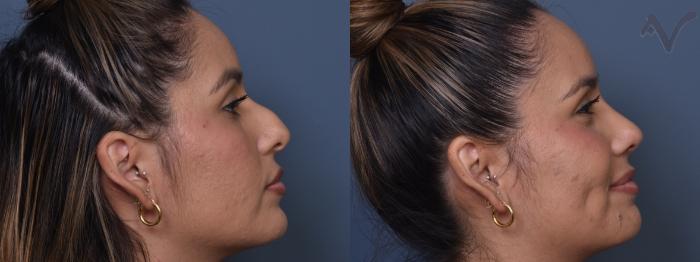 Before & After Rhinoplasty Case 370 Right Side View in Los Angeles, CA