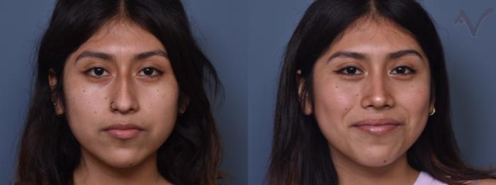 Before & After Rhinoplasty Case 371 Front View in Los Angeles, CA
