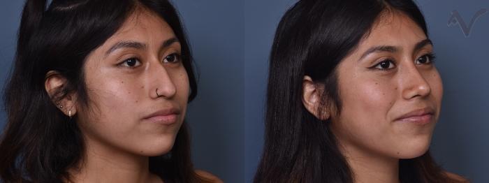 Before & After Rhinoplasty Case 371 Right Oblique View in Los Angeles, CA