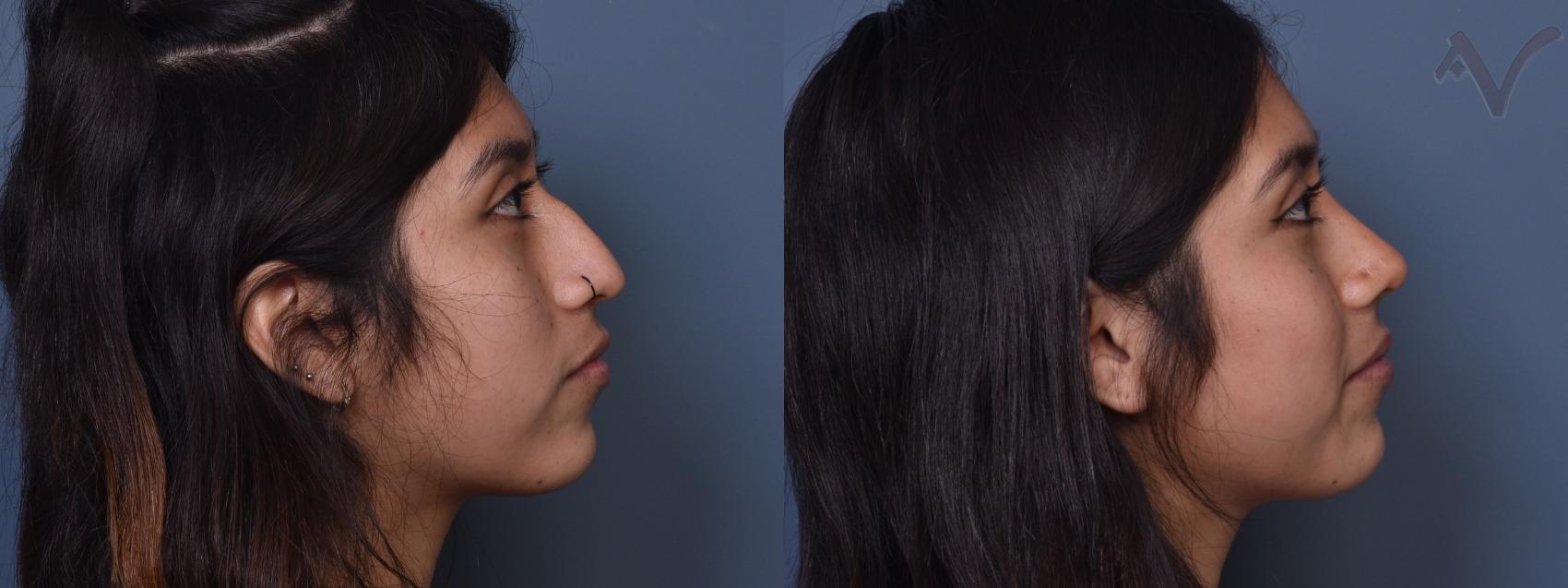 Before & After Rhinoplasty Case 371 Right Side View in Los Angeles, CA