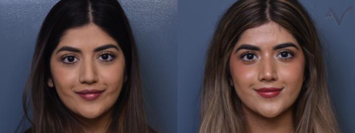 Before & After Rhinoplasty Case 372 Front View in Los Angeles, CA