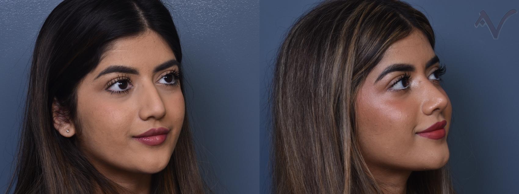 Before & After Rhinoplasty Case 372 Right Oblique View in Los Angeles, CA