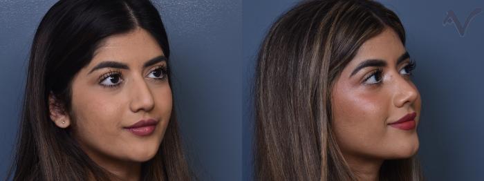 Before & After Rhinoplasty Case 372 Right Oblique View in Los Angeles, CA