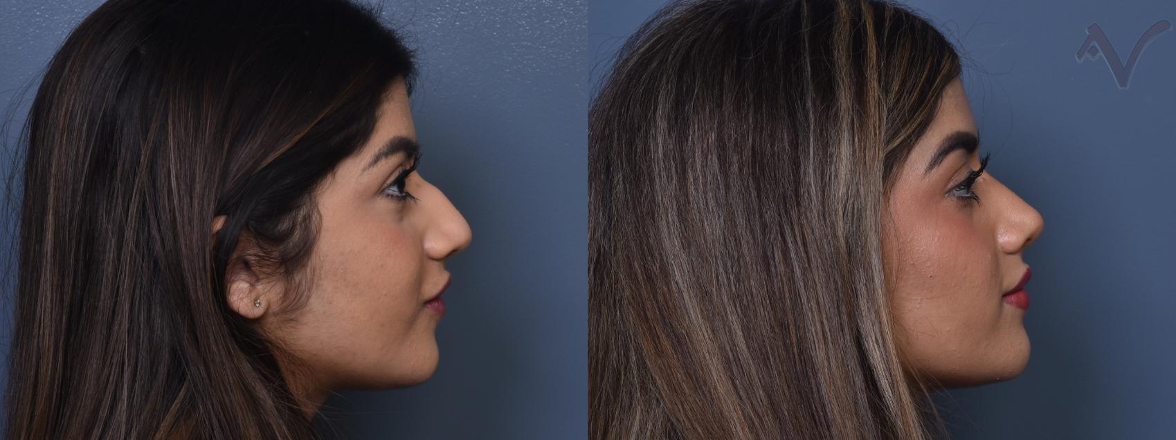 Before & After Rhinoplasty Case 372 Right Side View in Los Angeles, CA