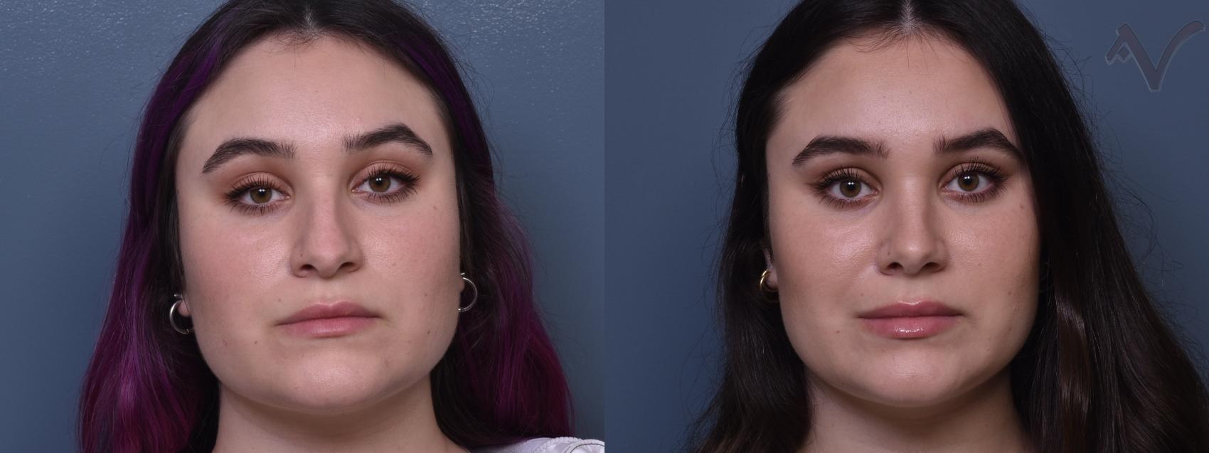 Before & After Rhinoplasty Case 373 Front View in Los Angeles, CA