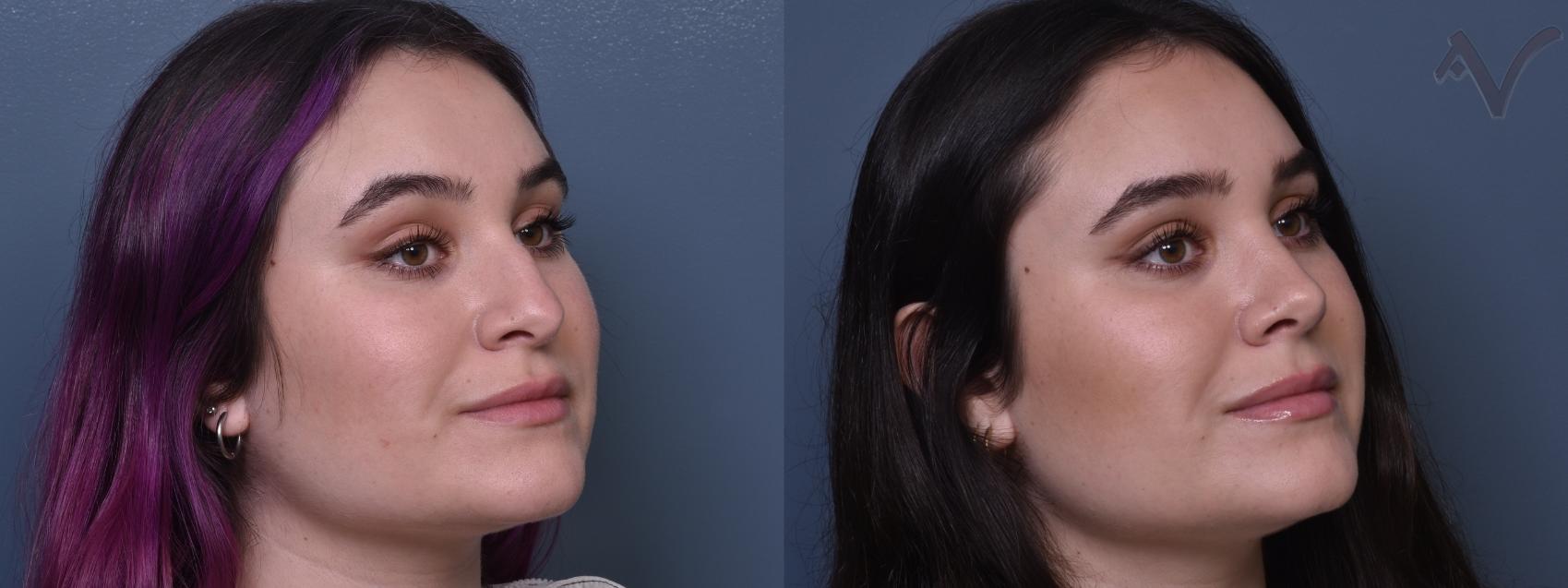Before & After Rhinoplasty Case 373 Right Oblique View in Los Angeles, CA