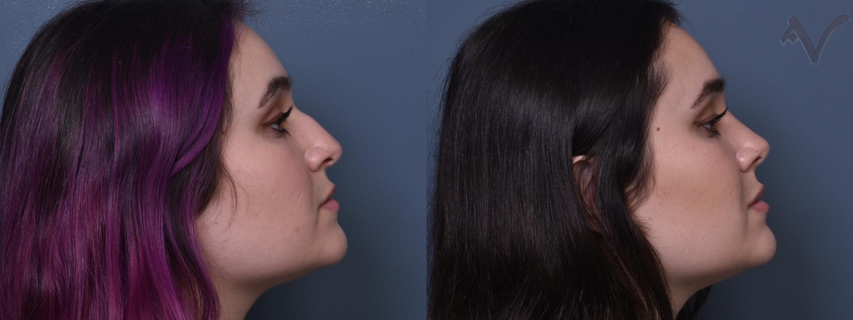 Before & After Rhinoplasty Case 373 Right Side View in Los Angeles, CA