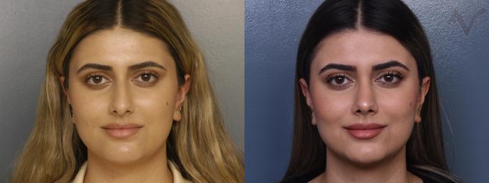 Before & After Rhinoplasty Case 374 Front View in Los Angeles, CA