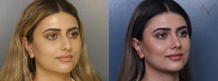Before & After Rhinoplasty Case 374 Right Oblique View in Los Angeles, CA