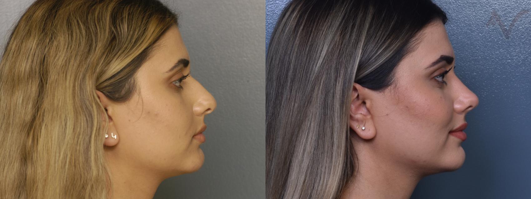 Before & After Rhinoplasty Case 374 Right Side View in Los Angeles, CA