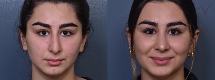 Before & After Rhinoplasty Case 377 Front View in Los Angeles, CA