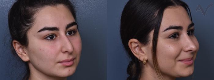 Before & After Rhinoplasty Case 377 Right Oblique View in Los Angeles, CA