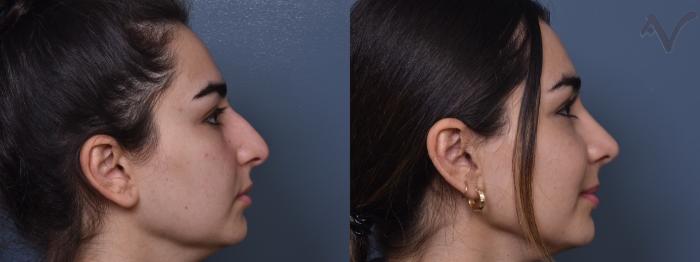 Before & After Rhinoplasty Case 377 Right Side View in Los Angeles, CA