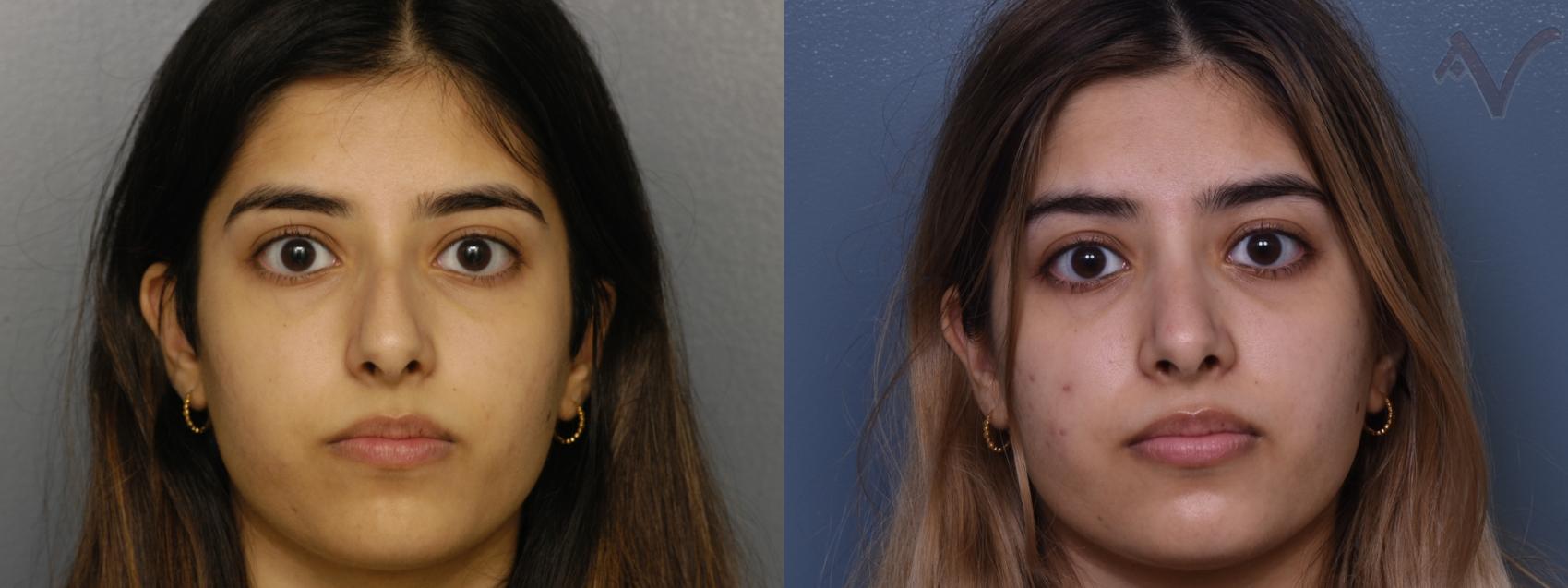 Before & After Rhinoplasty Case 379 Front View in Los Angeles, CA