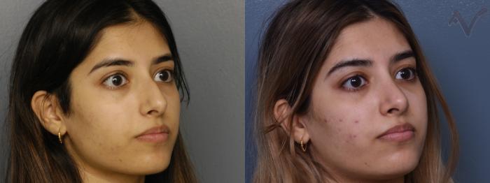 Before & After Rhinoplasty Case 379 Right Oblique View in Los Angeles, CA