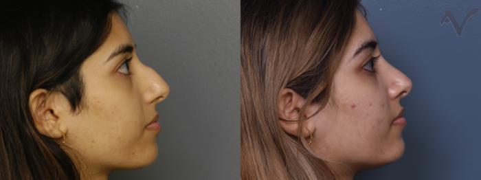 Before & After Rhinoplasty Case 379 Right Side View in Los Angeles, CA