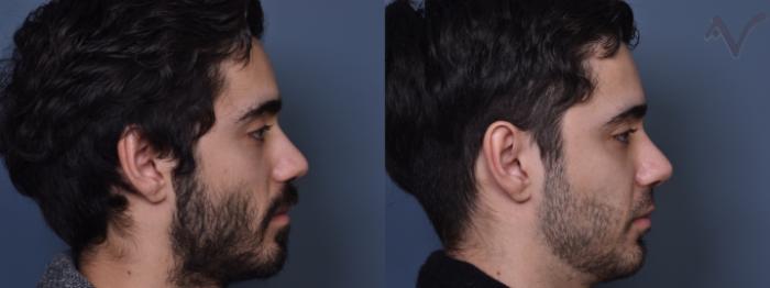 Before & After Rhinoplasty Case 381 Right Side View in Los Angeles, CA