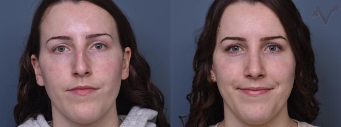 Before & After Rhinoplasty Case 384 Front View in Los Angeles, CA