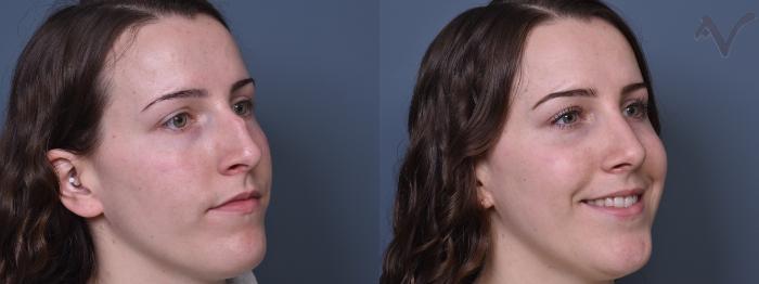 Before & After Rhinoplasty Case 384 Right Oblique View in Los Angeles, CA