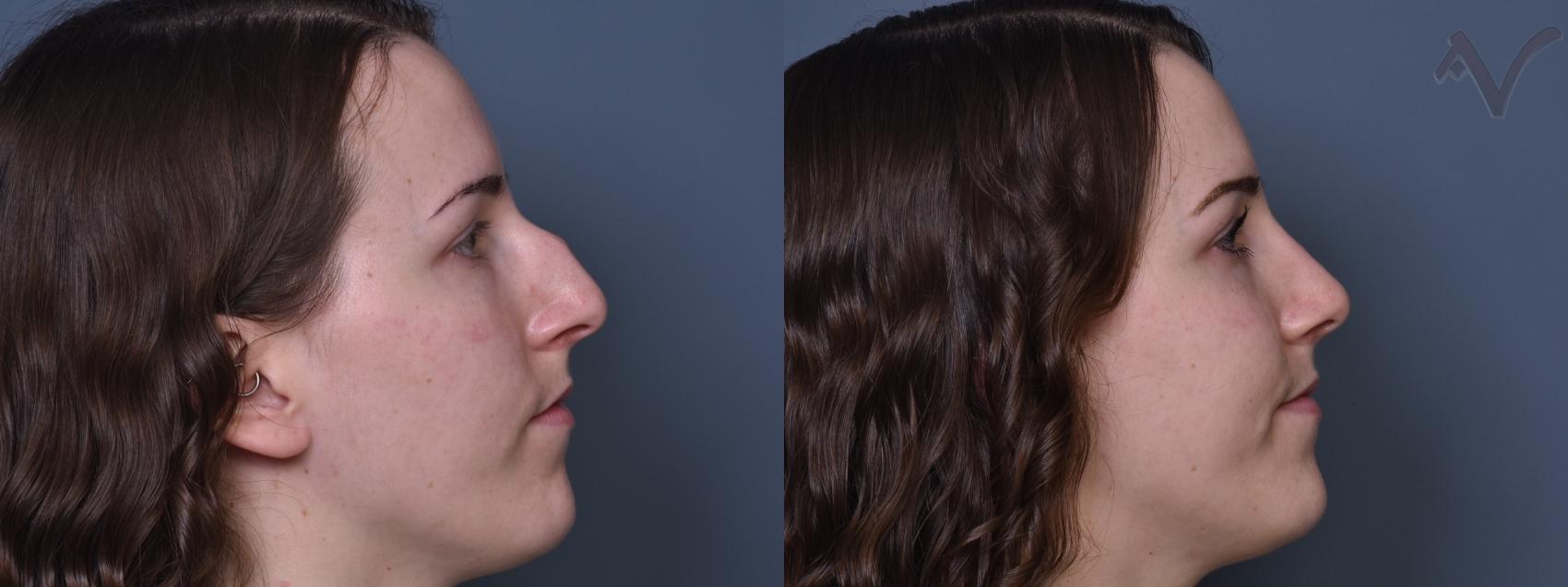 Before & After Rhinoplasty Case 384 Right Side View in Los Angeles, CA