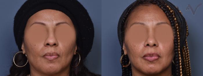 Before & After Rhinoplasty Case 389 Front View in Los Angeles, CA