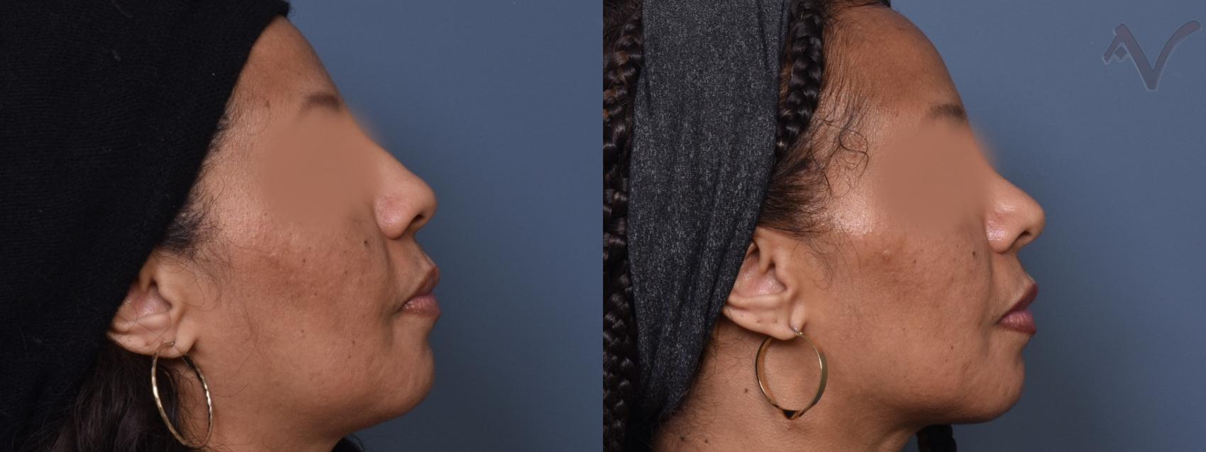 Before & After Rhinoplasty Case 389 Right Side View in Los Angeles, CA