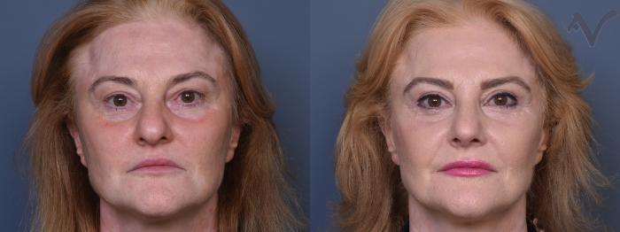Before & After Rhinoplasty Case 391 Front View in Los Angeles, CA