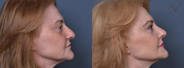 Before & After Rhinoplasty Case 391 Right Side View in Los Angeles, CA