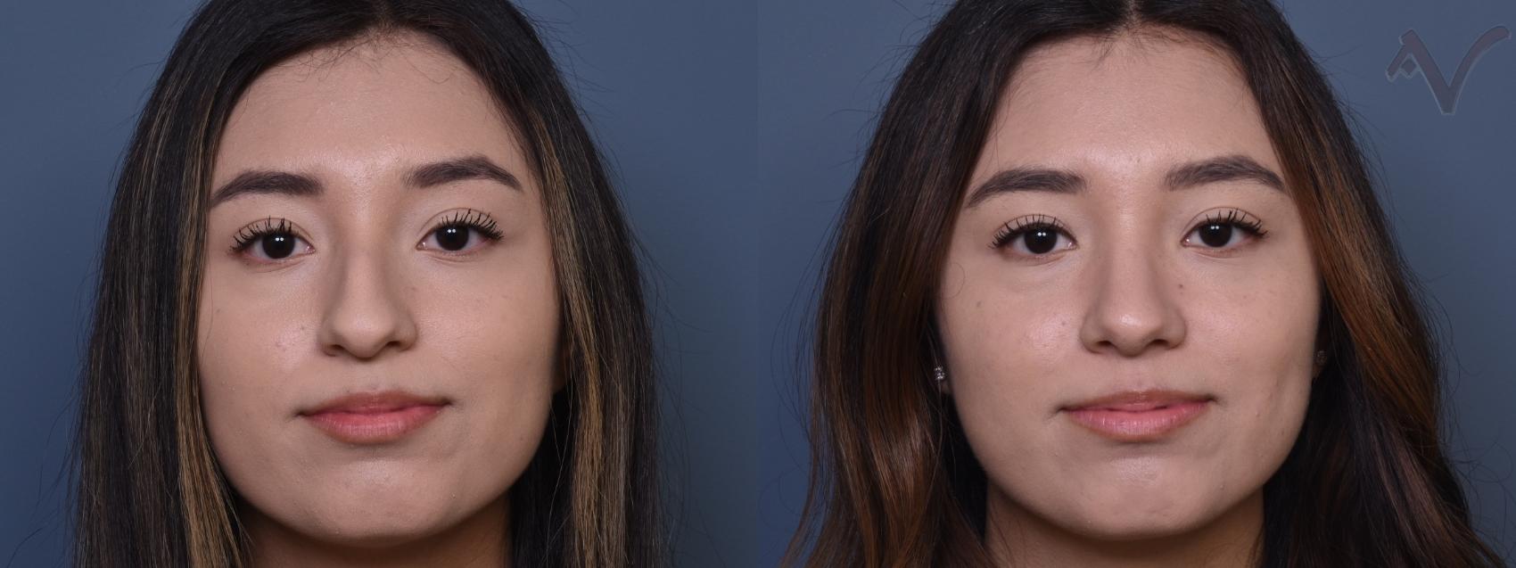 Rhinoplasty Before and After Pictures Case 393 | Los Angeles, CA ...