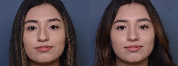 Before & After Rhinoplasty Case 393 Front View in Los Angeles, CA