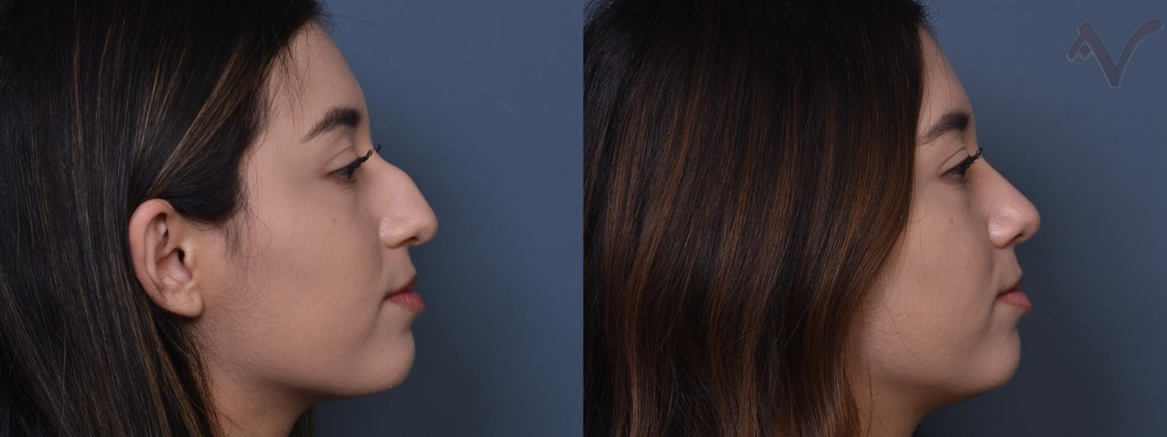 Before & After Rhinoplasty Case 393 Right Side View in Los Angeles, CA