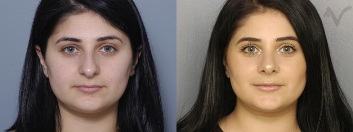 Before & After Rhinoplasty Case 4 Front View in Los Angeles, CA