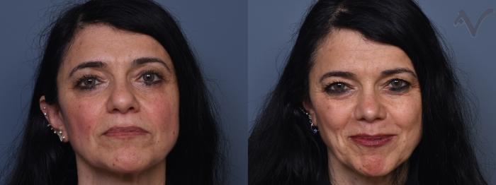 Before & After Rhinoplasty Case 401 Front View in Los Angeles, CA