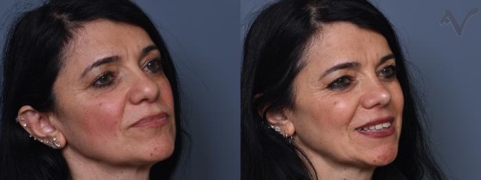 Before & After Rhinoplasty Case 401 Right Oblique View in Los Angeles, CA