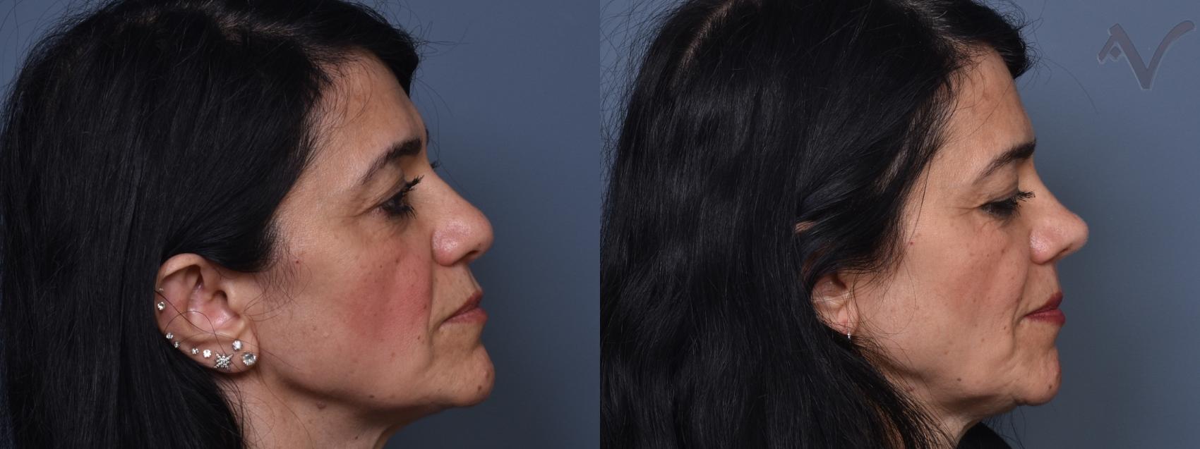 Before & After Rhinoplasty Case 401 Right Side View in Los Angeles, CA