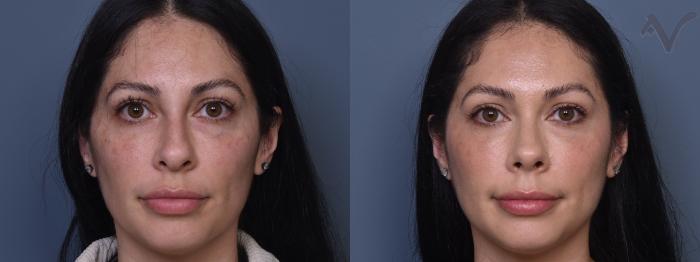 Before & After Rhinoplasty Case 402 Front View in Los Angeles, CA