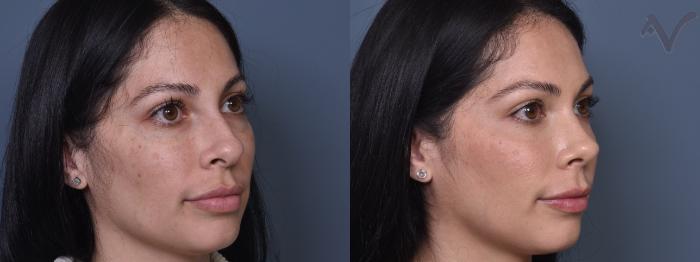 Before & After Rhinoplasty Case 402 Right Oblique View in Los Angeles, CA