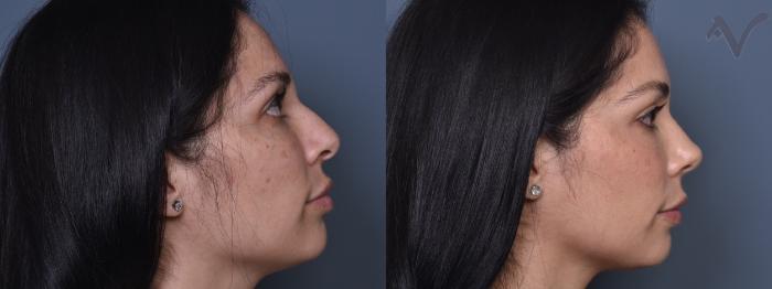 Before & After Rhinoplasty Case 402 Right Side View in Los Angeles, CA