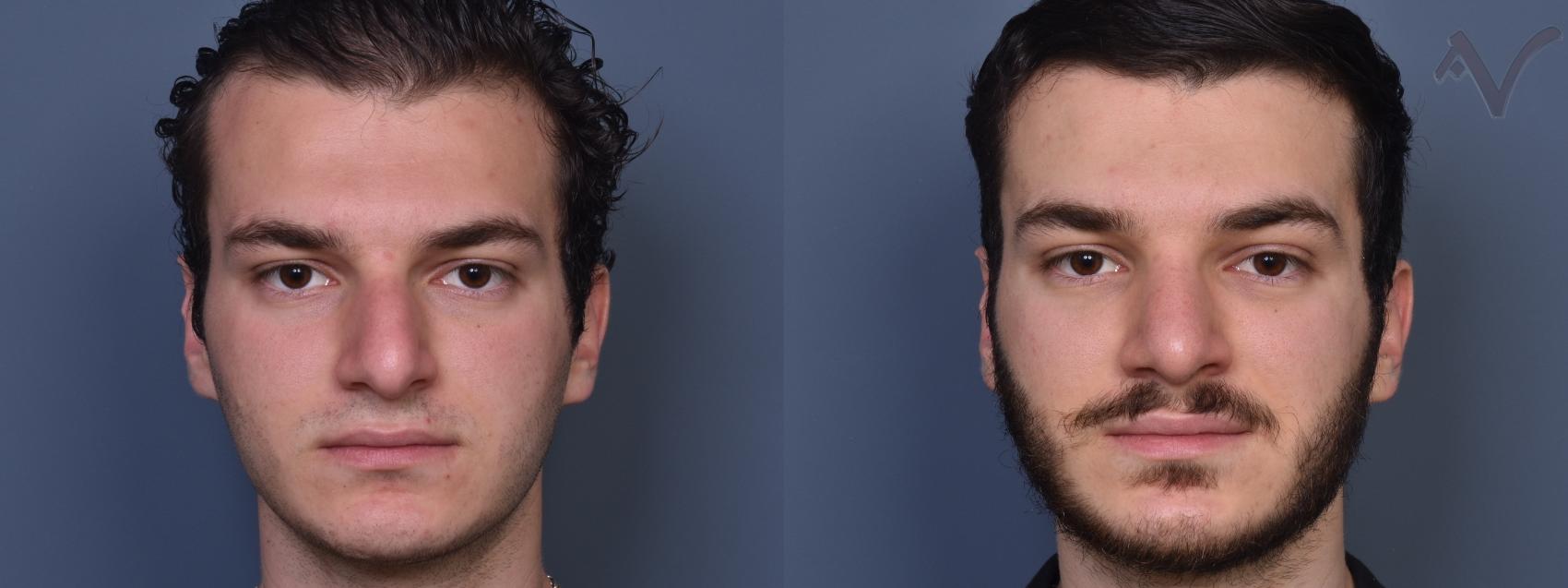 Before & After Rhinoplasty Case 403 Front View in Los Angeles, CA