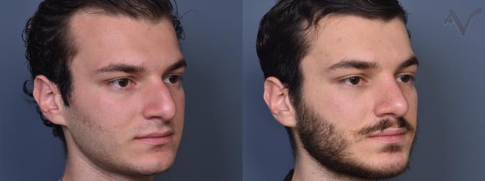 Before & After Rhinoplasty Case 403 Right Oblique View in Los Angeles, CA