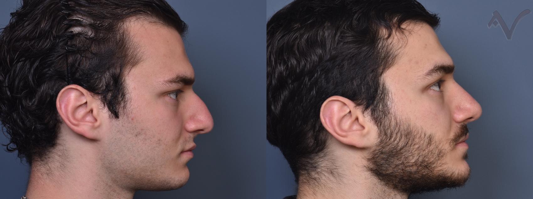 Before & After Rhinoplasty Case 403 Right Side View in Los Angeles, CA