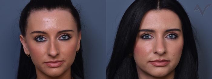 Before & After Rhinoplasty Case 404 Front View in Los Angeles, CA