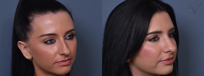 Before & After Rhinoplasty Case 404 Right Oblique View in Los Angeles, CA