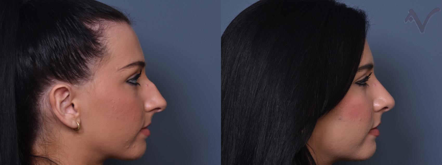 Before & After Rhinoplasty Case 404 Right Side View in Los Angeles, CA