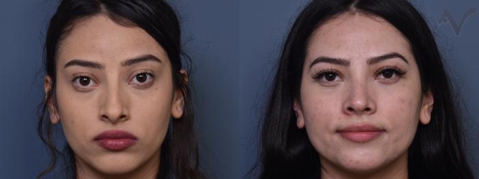 Before & After Rhinoplasty Case 406 Front View in Los Angeles, CA