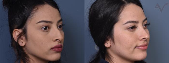 Before & After Rhinoplasty Case 406 Right Oblique View in Los Angeles, CA