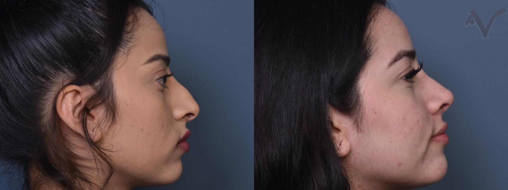 Before & After Rhinoplasty Case 406 Right Side View in Los Angeles, CA